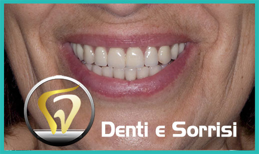 Dentista-all-on-four-prezzi a Aversa 12