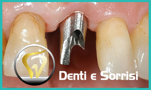 Dentista-all-on-four-prezzi a Paola 13