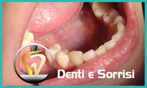 Dentista-all-on-four-prezzi a Sant'Arcangelo 15