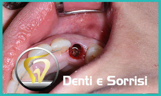 Dentista-all-on-four-prezzi a Scanzano Jonico 16