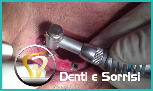 Dentista-all-on-four-prezzi a Cologno Monzese 18
