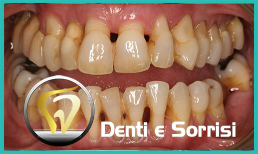 Dentista-all-on-four-prezzi a Cento 23
