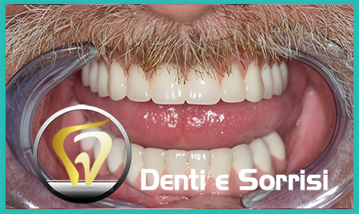 Dentista-all-on-four-prezzi a Larino 24