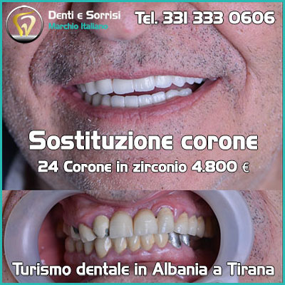 Dentista-all-on-four-prezzi a Novi Ligure 29