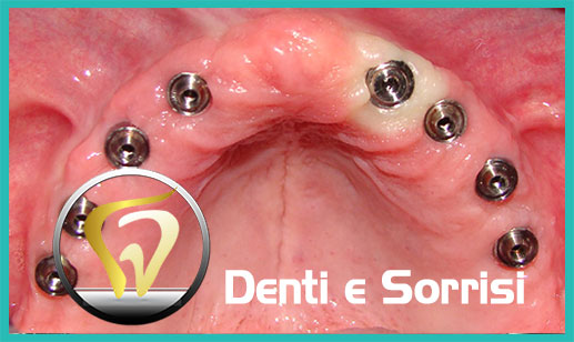 Dentista-all-on-six-prezzi-a-Formia 11