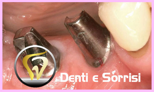dentista-low-cost-in-repubblica-ceca-20