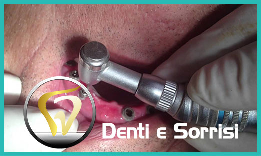 Dentista low cost Formia 18