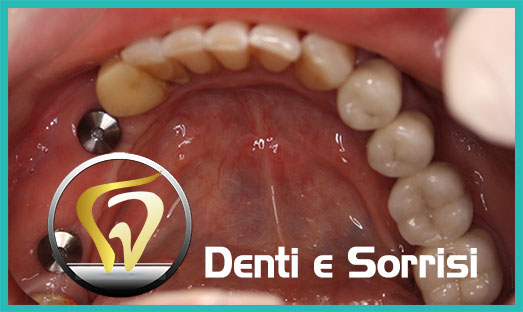 Dentista low cost Formia 19