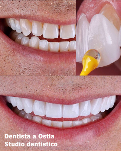 dentista-Ostia-estetica-dentale-con-faccette-dentali
