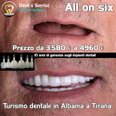 Turismo-dentale-in-albania-a-tirana-36