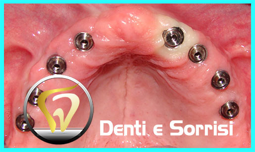 dentista-low-cost-a-valona-11