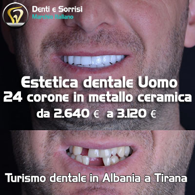 prezzo-corona-in-ceramica-zirconio-in-Albania-a-Tirana-durazzo-valona-28