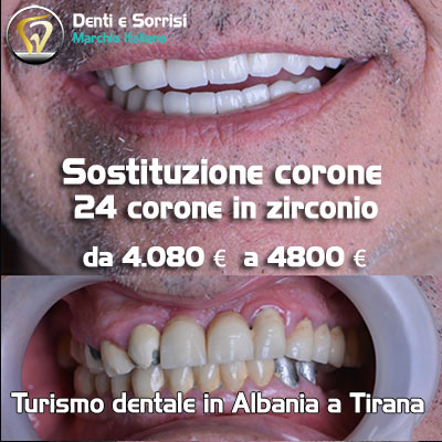prezzo-corona-in-zirconio-in-Albania-a-Tirana-durazzo-valona-29