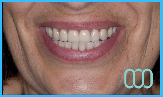 prezzo-corona-in-ceramica-e-max-veneers-12