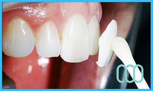 prezzo-corona-in-ceramica-e-max-veneers-17