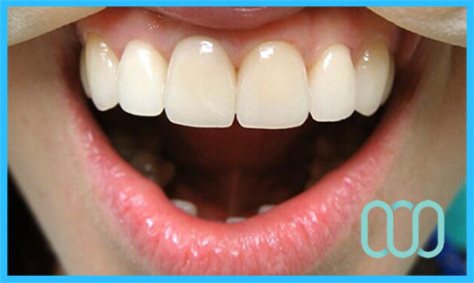 prezzo-corona-in-ceramica-e-max-veneers-21