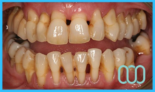 prezzo-corona-in-ceramica-e-max-veneers-23