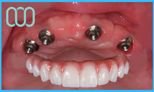 prezzo-corona-in-ceramica-e-max-veneers-7