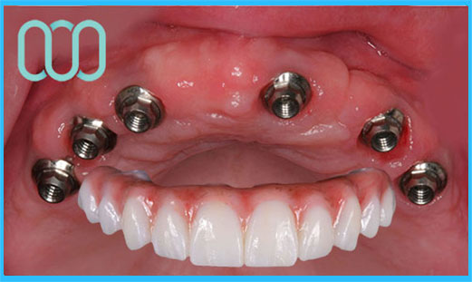 prezzo-corona-in-ceramica-e-max-veneers-8