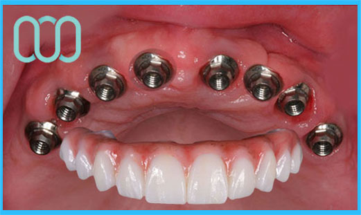 prezzo-corona-in-ceramica-e-max-veneers-9