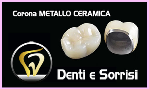 prezzo-all-on-eight-con-14-denti-in-metallo-ceramica-e-8-impianti-in-titanio-1