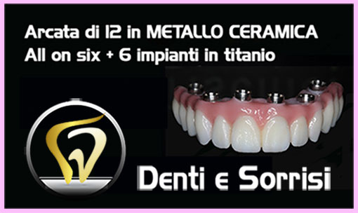 prezzo-all-on-four-con-12-denti-in-resina-e-4-mpianti-in-titanio-8