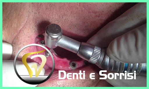 dentista-low-cost-a-belgrado-18