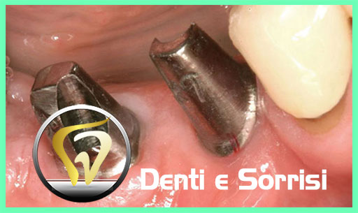 dentista-low-cost-a-belgrado-20