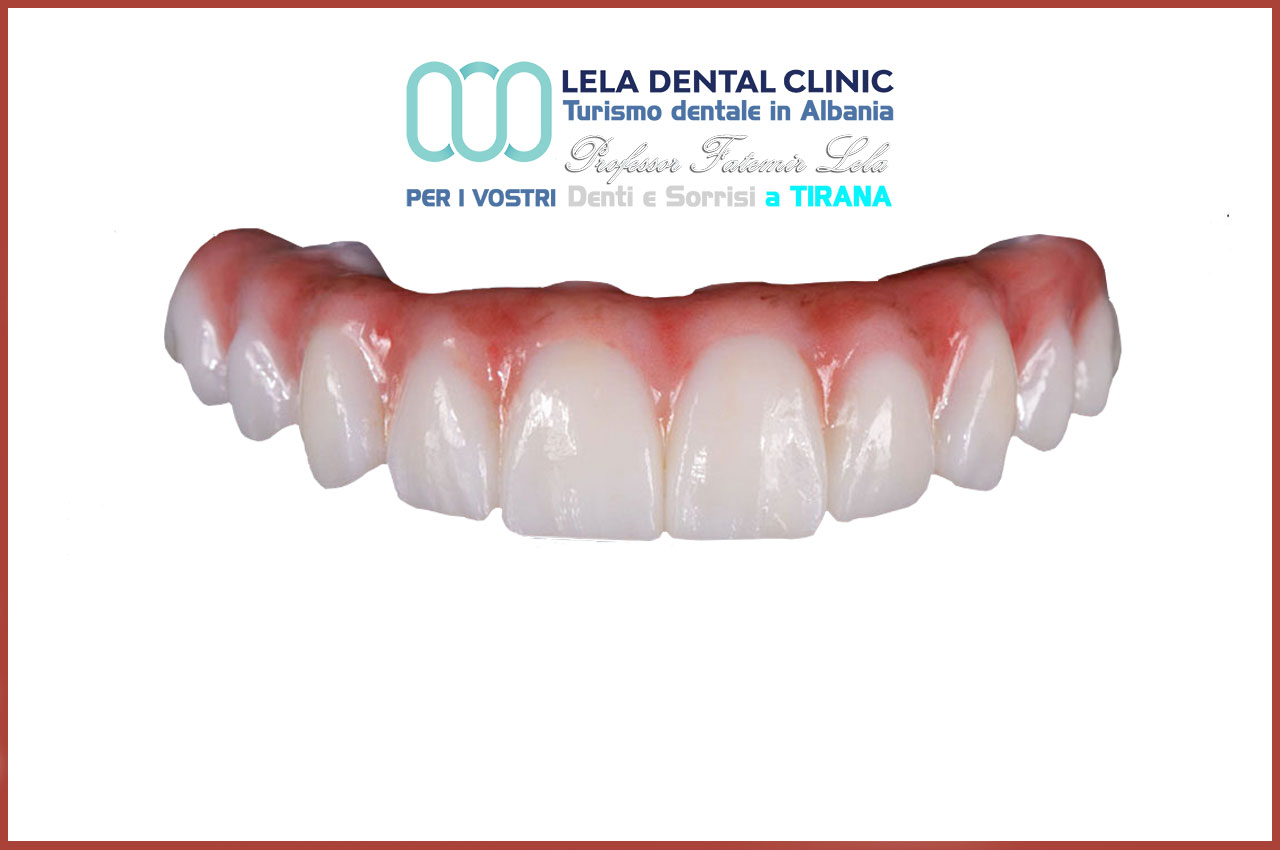 notizie-arcata-dentale-in-zirconio