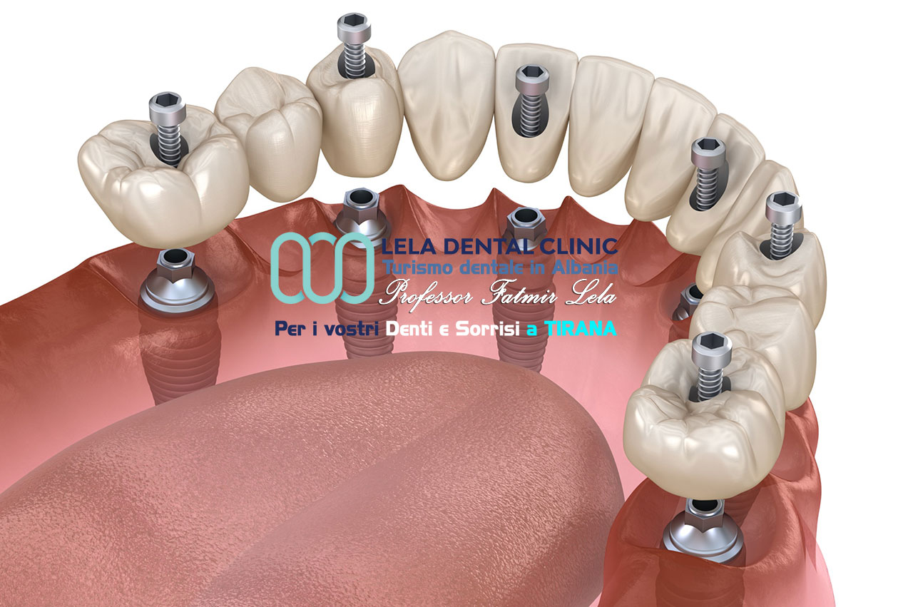 notizie-sulle-arcate-dentale-avvitate