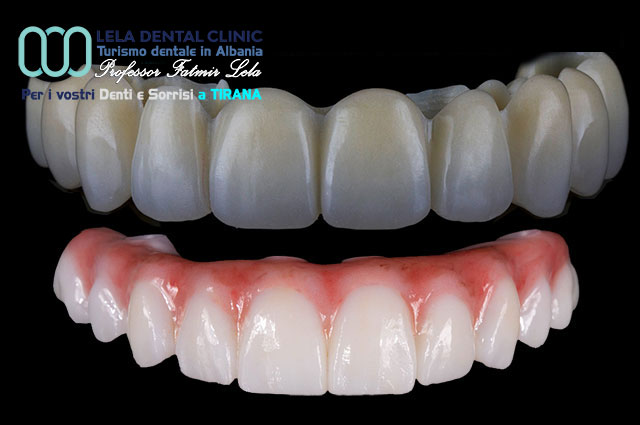 blog-arcate-dentali-in-zirconio
