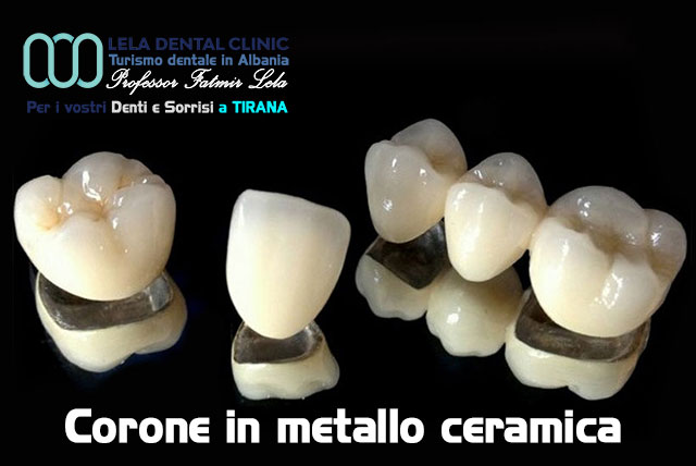 blog-corona-in-metallo-ceramica