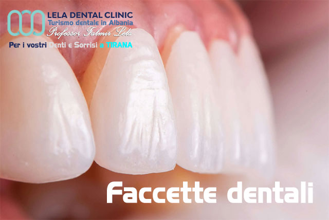 blog-faccette-dentali-emax