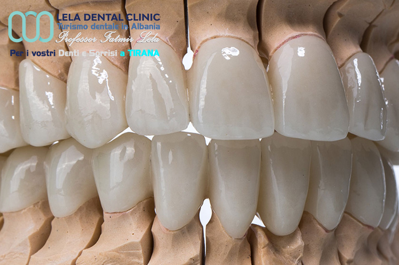 blog-protesi-dentali