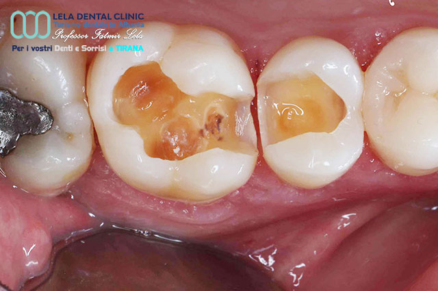 blog-cura-canalare-dei-denti