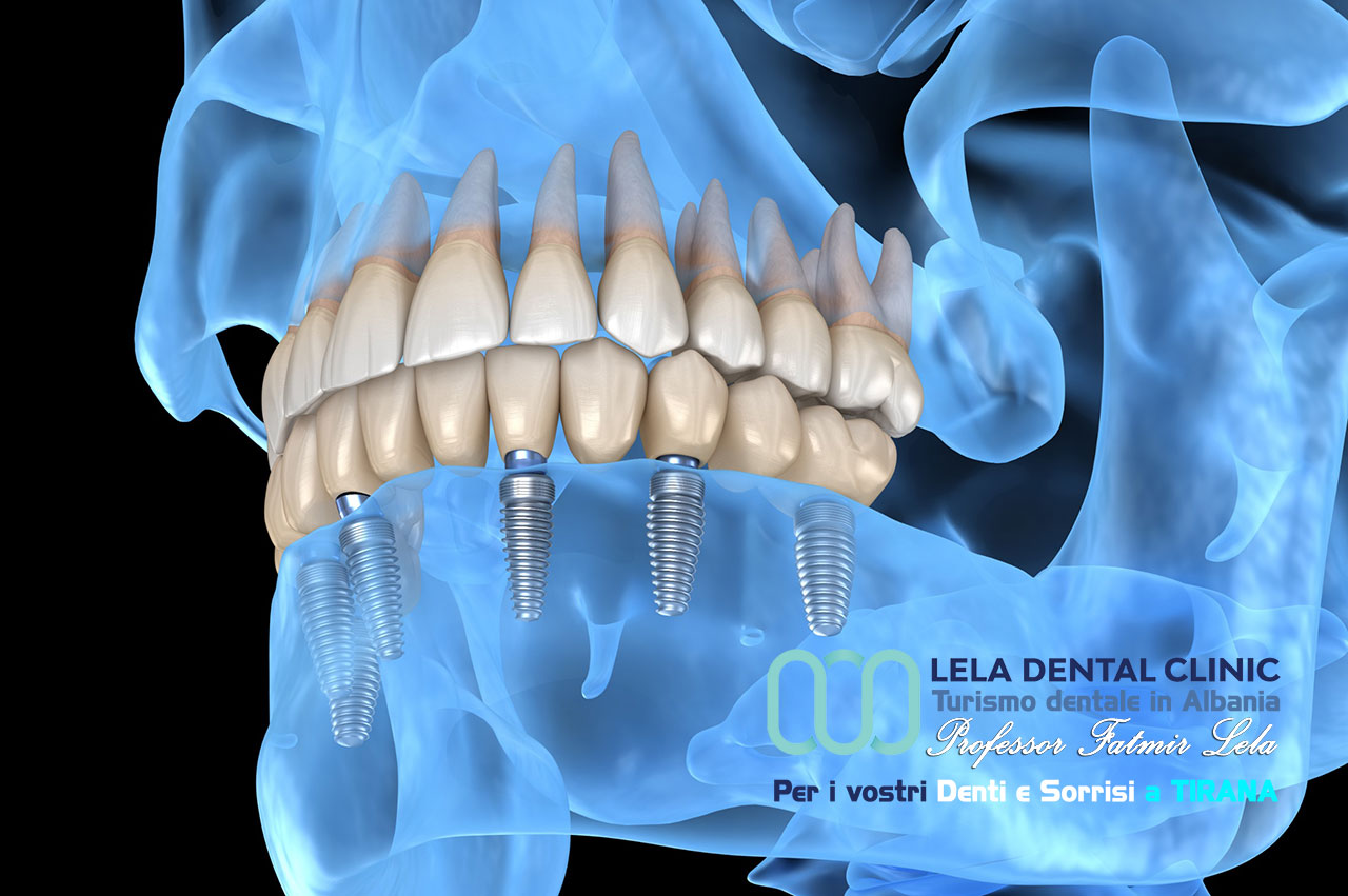 notizie-impianti-dentali-per-arcate