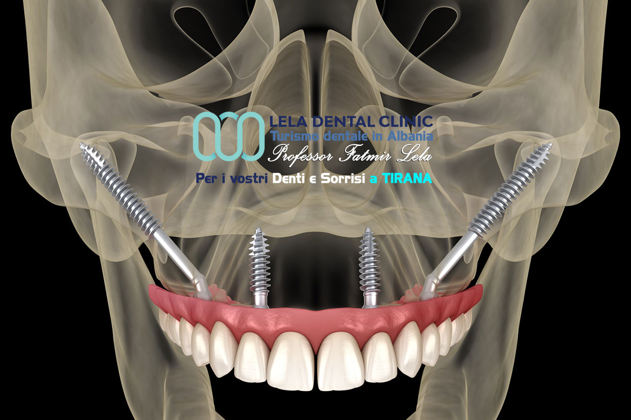 notizie-impianti-dentali-zigomatici