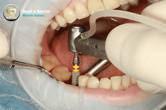 blog-inserimento-di-un-impianto-dentale