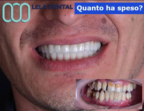 3-impianti-dentali-e-24-denti-in-zirconio