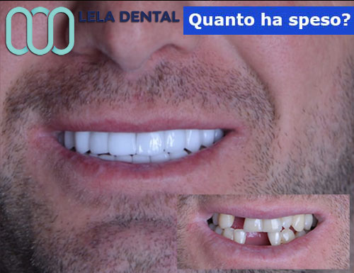 4-impianti-e-24-denti-in-zirconio