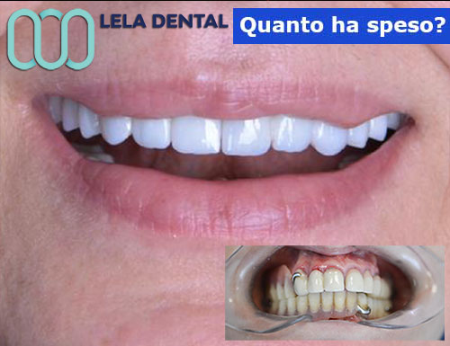 7-impianti-dentali-e-24-corone-in-zirconio