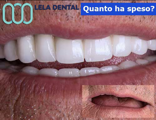 All-on-Six-con-denti-in-zirconio
