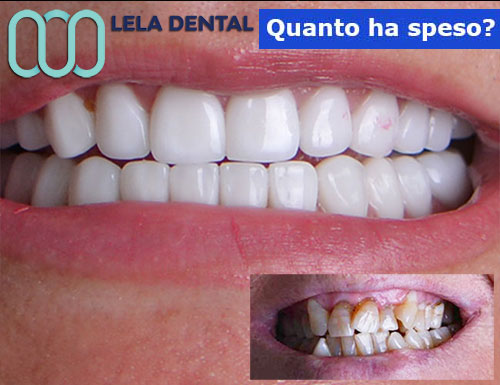all-on-four-con-24-denti-in-zirconio