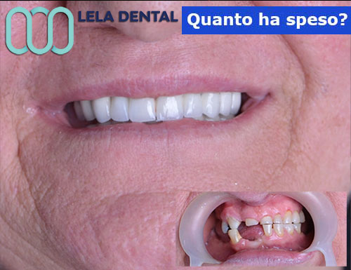 aumento-osso-con-4-impianti-dentali-e-24-denti-in-zirconio