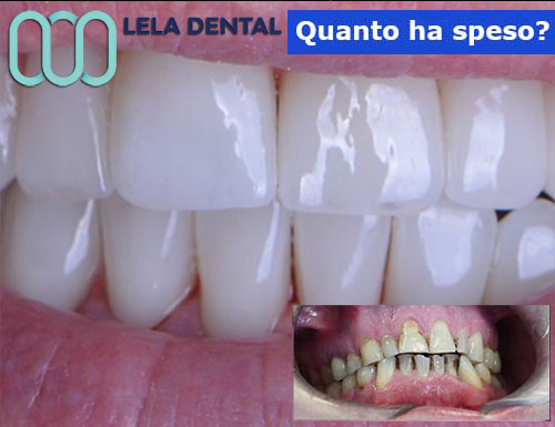 cure-dentali-e-24-denti-in-zirconio