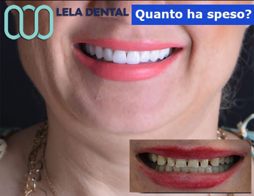 estetica-dentale-con-24-denti-in-zirconio