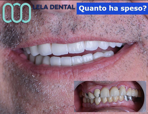 sostituzione-di-24-denti-metallo-ceramica-con-24-denti-in-zirconio