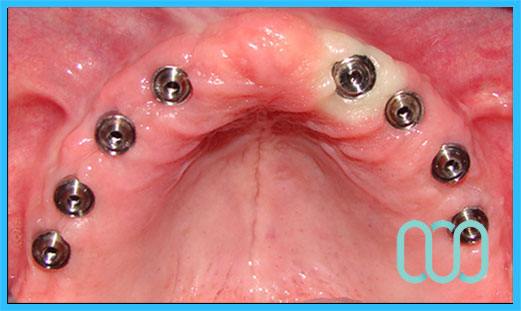 Dentista-low-cost-Cuneo prezzi 11