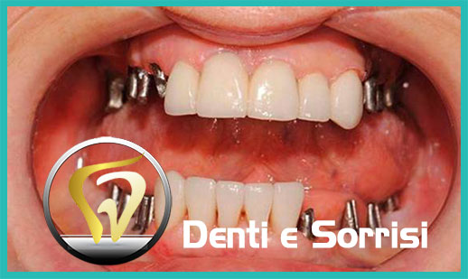 Dentista low cost Sassari prezzi 14