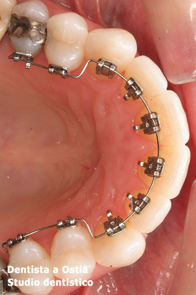 dentista-Ostia-apparecchio-linguale-fisso